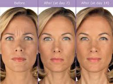 Botox, Lip Fillers, Vitamin injections, Dermal Fillers, Polynucleotides, Preston, Leyland, Chorley, Penwortham